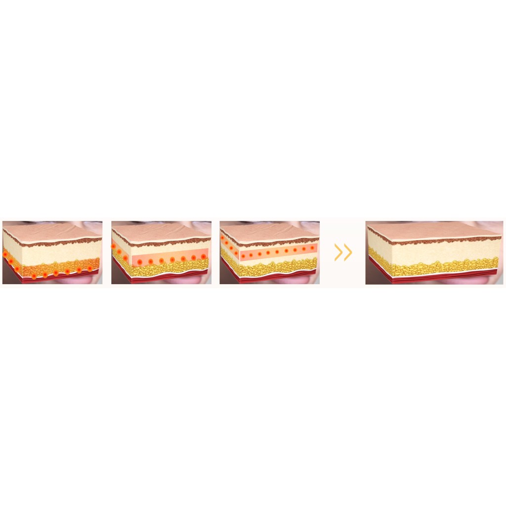 UTIMS A2S HIFU device with 3 transducers (1.5/3/4.5 mm) – UTIMS